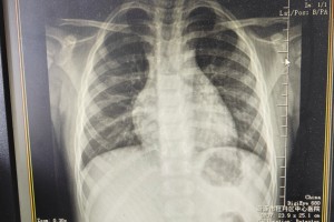 「黑龙江肺炎最新消息」〃黑龙江肺炎病例详情