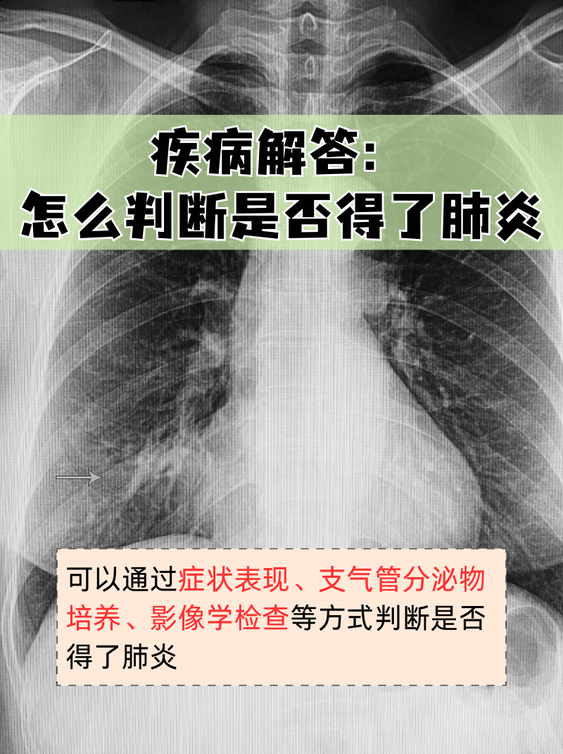 “肺炎今天新闻最新	” 今天肺炎新消息？-第3张图片