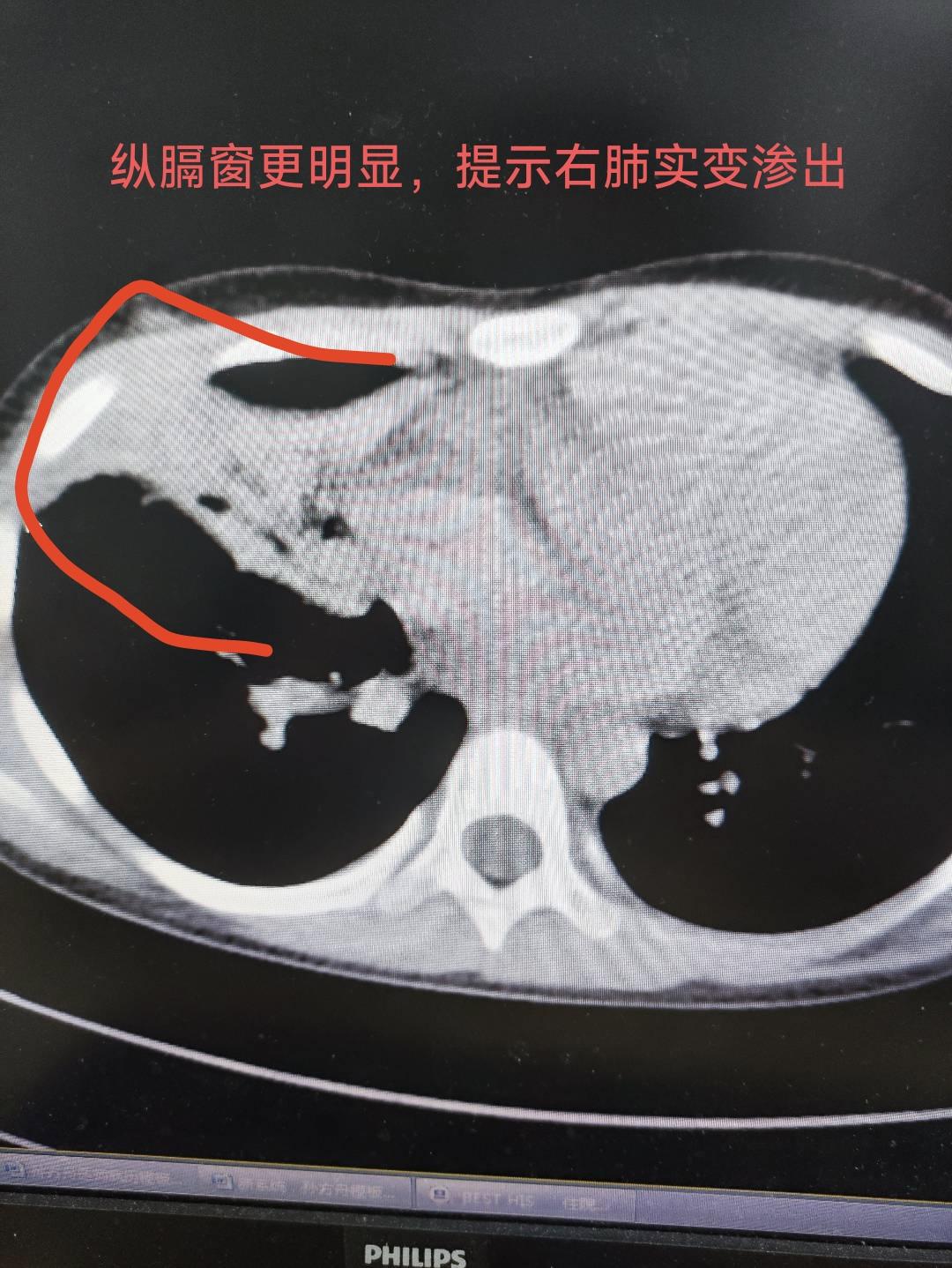 「沈阳肺炎病例」〃沈阳肺炎病例最新消息-第1张图片